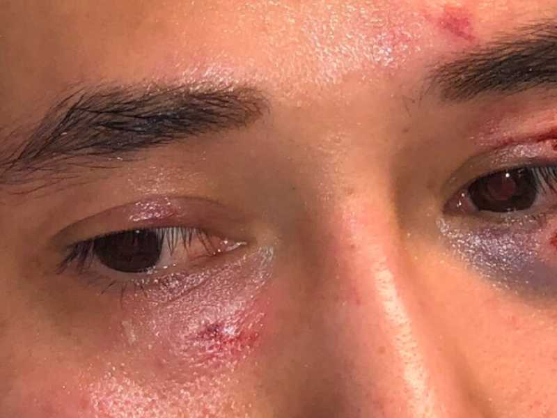Andy Ngo ricoverato in ospedale dopo essere stato aggredito (foto Twitter)