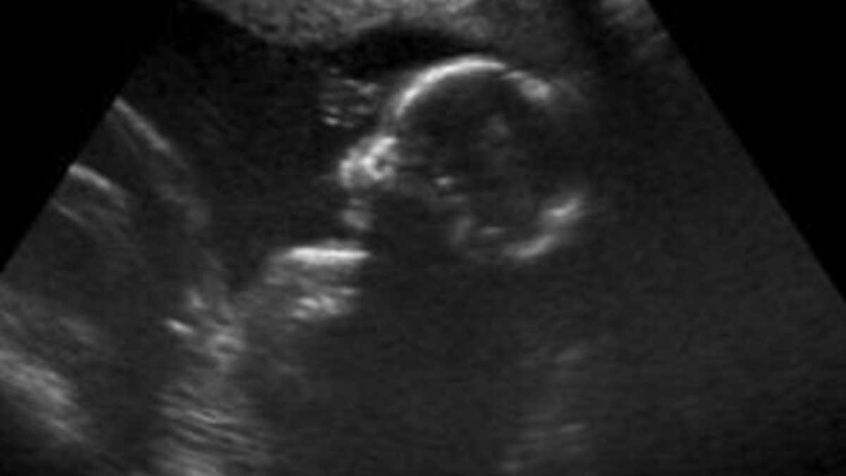 Immagine di In Inghilterra si bruciano bambini abortiti per riscaldare gli ospedali