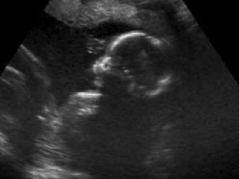 In Inghilterra si bruciano bambini abortiti per riscaldare gli ospedali
