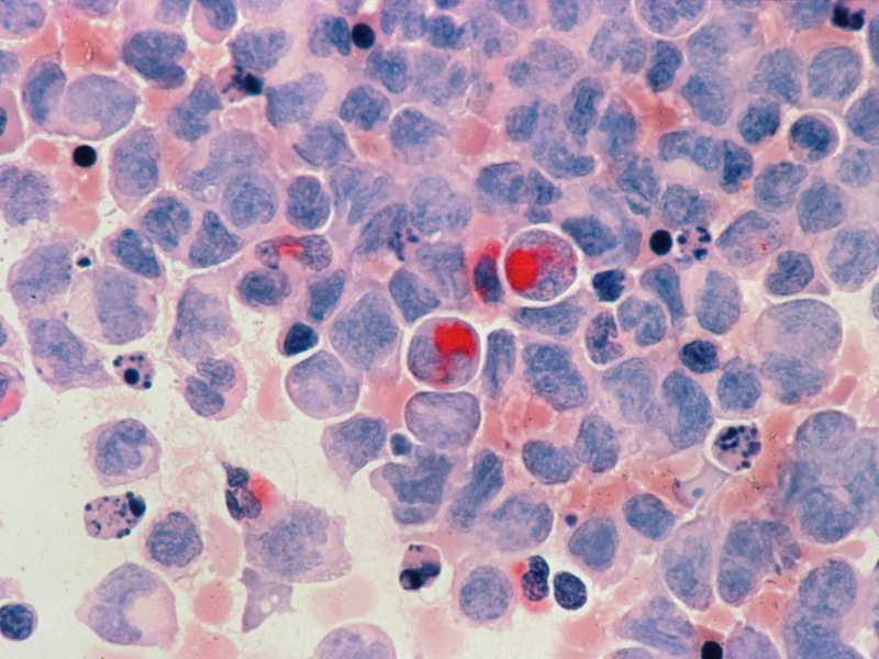 Cellule umane con leucemia mielocitica acuta (National Cancer Institute)&nbsp;<br />