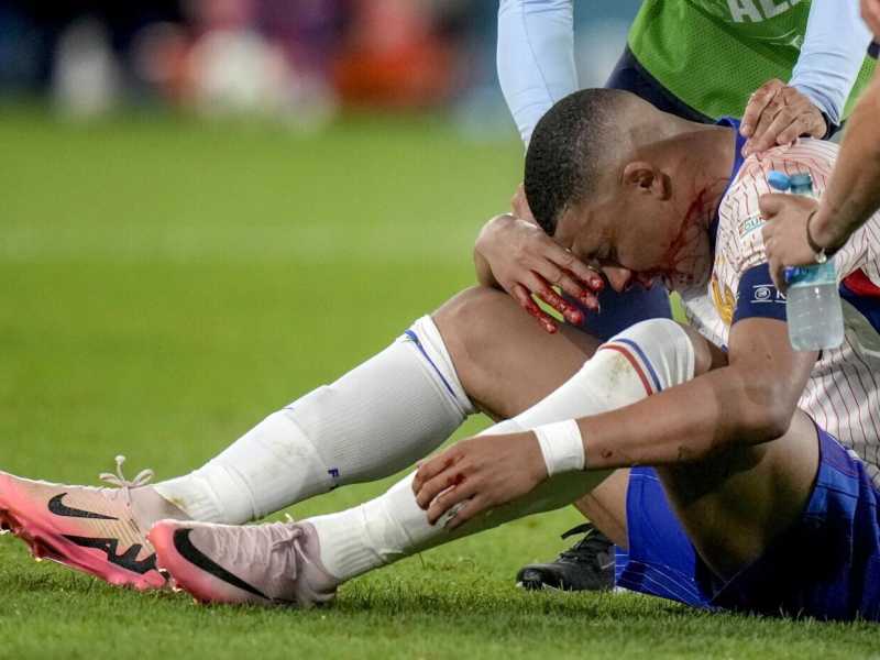 Kylian Mbapp&eacute; si &egrave; rotto il setto nasale nella prima partita della Francia a Euro 2024 (foto Ap, via LaPresse)